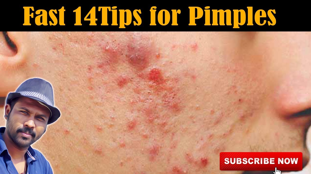 Fast 14 Ways to get rid of Pimples | Health Tips | Beauty Tips | Esh Vlog