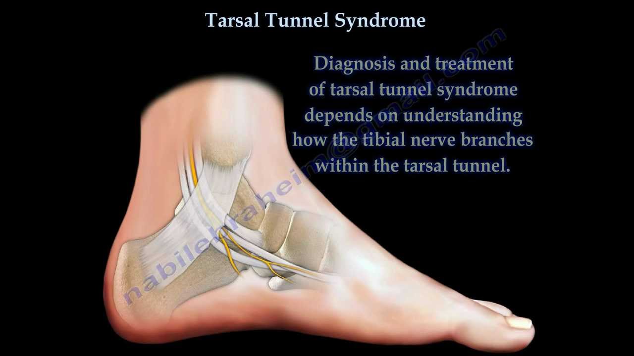 Tarsal Tunnel Syndrome - Everything You Need To Know - Dr. Nabil