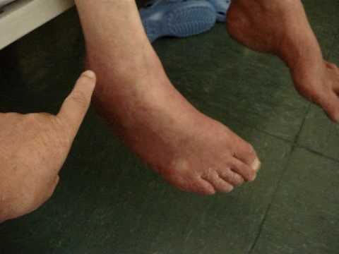 CIATICO POPLITEO EXTERNO :NEUROPATIA DIABETICA Y CARENCIAL CIATICO POPLITEO EXTERNO :NEUROPATIA DIABETICA Y CARENCIAL