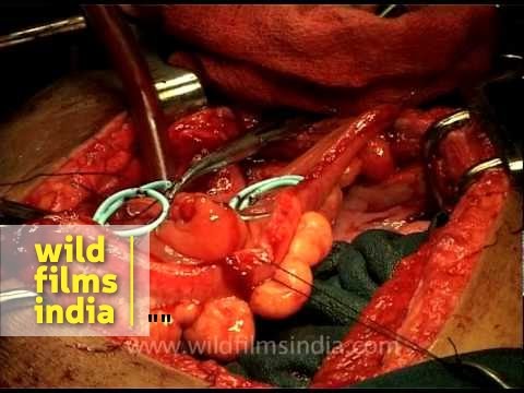 Internal stitching during Abdominal surgery! - YouTube