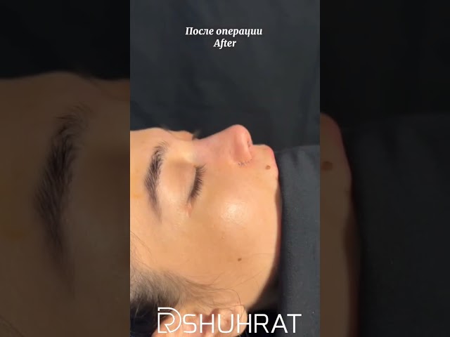 Rhinoplasty before and after