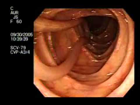 Parasites - Round Worm Found in Human Colon - YouTube