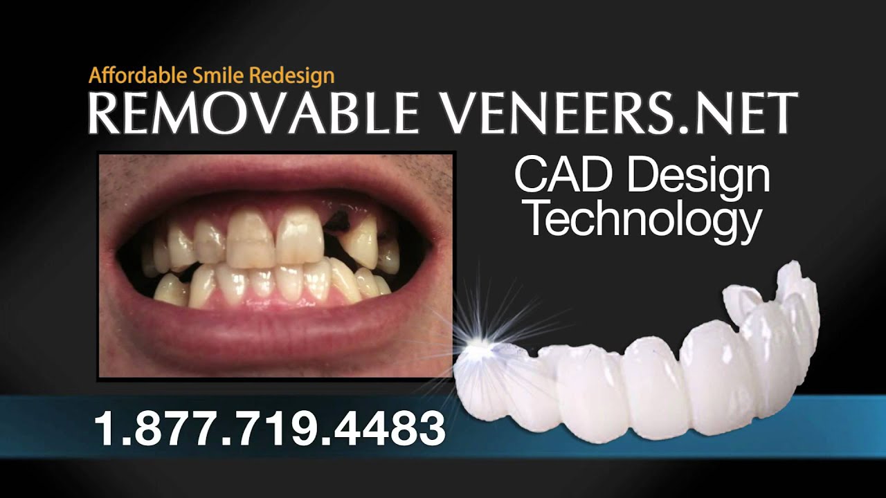 A Snap On Smile Alternative Local Dentist YouTube