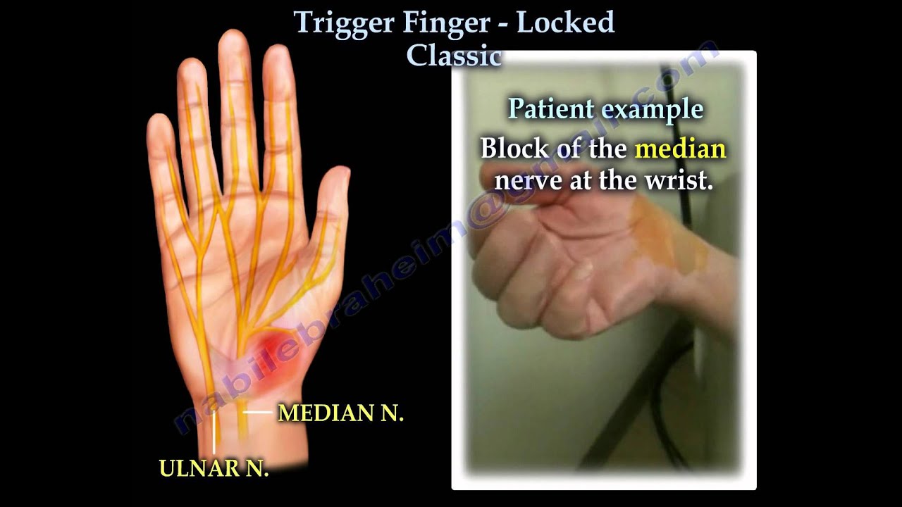 Trigger Finger Locked classic Everything You Need To Know Dr. Nabil Ebraheim YouTube