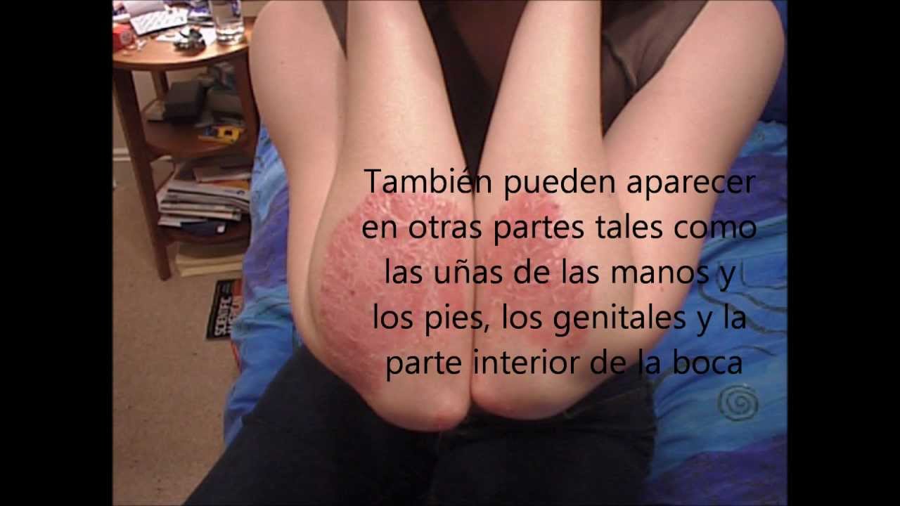La psoriasis sobre la cabeza como quitar el picor