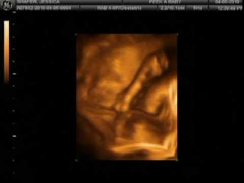 Black And White 4d Ultrasound. 3D/4D Ultrasound at 29 Weeks