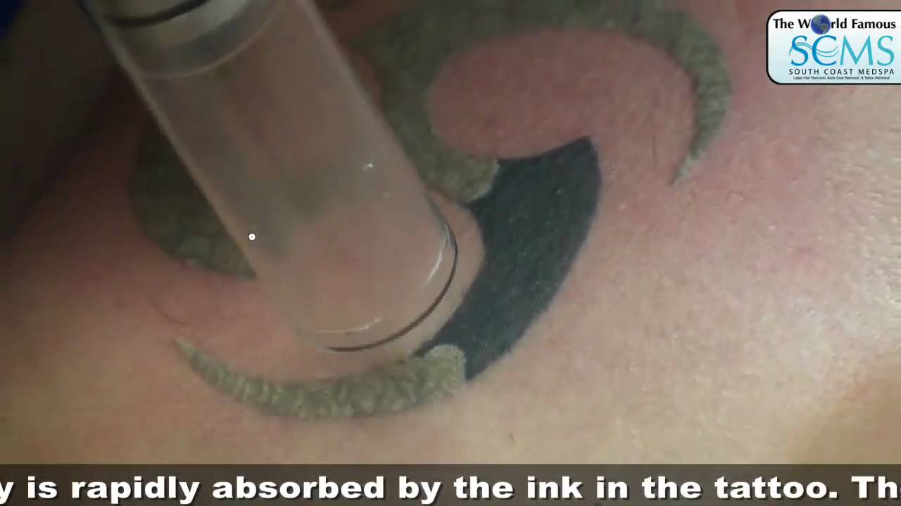 Laser Tattoo Removal - YouTube