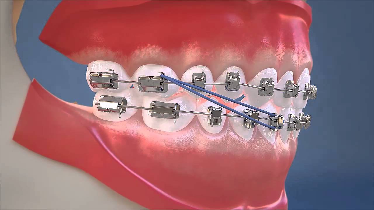Class III Elastics Lateral View (HD) YouTube
