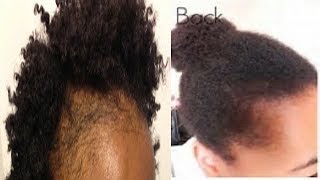 HOW TO TREAT BALD HAIR AND REGROW YOUR BALD HAIR SPOT NATURALLY