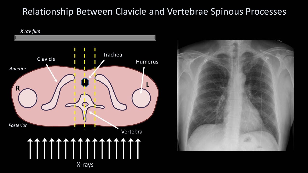 How to Interpret a Chest XRay (Lesson 3 Assessing Technical Quality