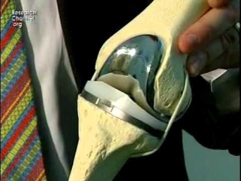 Knee: Minimally Invasive Total Knee Replacement Surgery Part 1 - YouTube