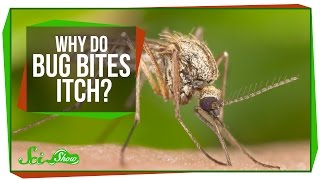 Why Do Bug Bites Itch?