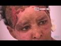 Gaddafi's Son Wife Burnt The Face Of Ethiopian Woman - Cnn 