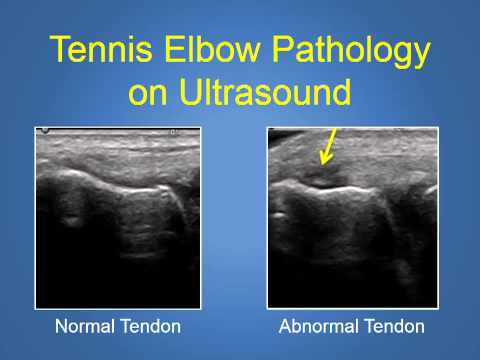 Elbow Arthroscopy For Epicondylitis