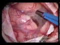 Brain Surgery: Removal of Metastatic Tumor