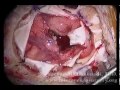 Brain Surgery: Removal of Metastatic Tumor