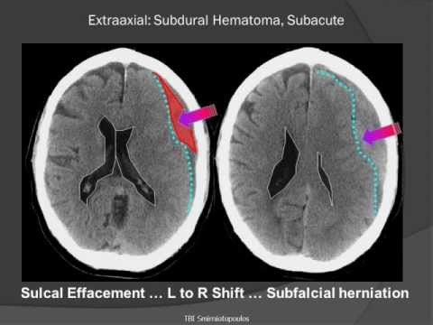 mild stroke after surgical operation