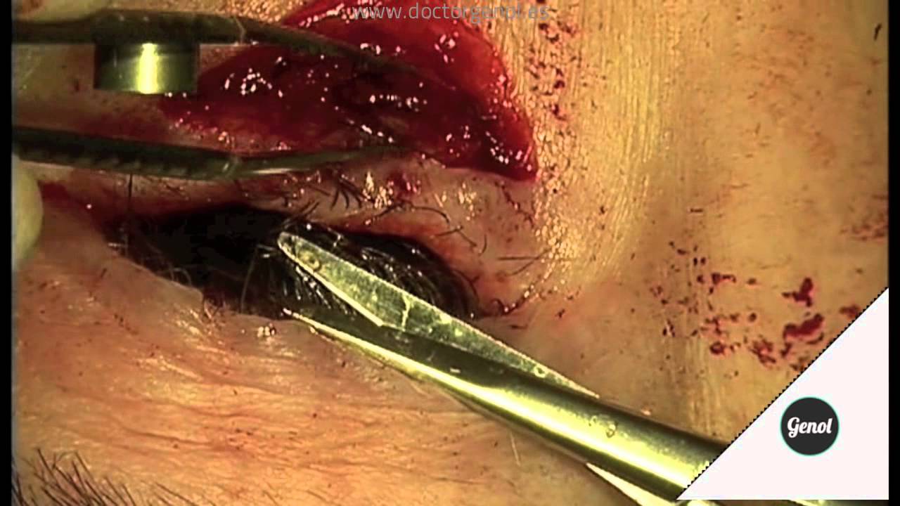 Lower eyelid entropion. Retractors plication and everting sutures - YouTube