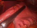 Gastrectomía tubular laparoscópica