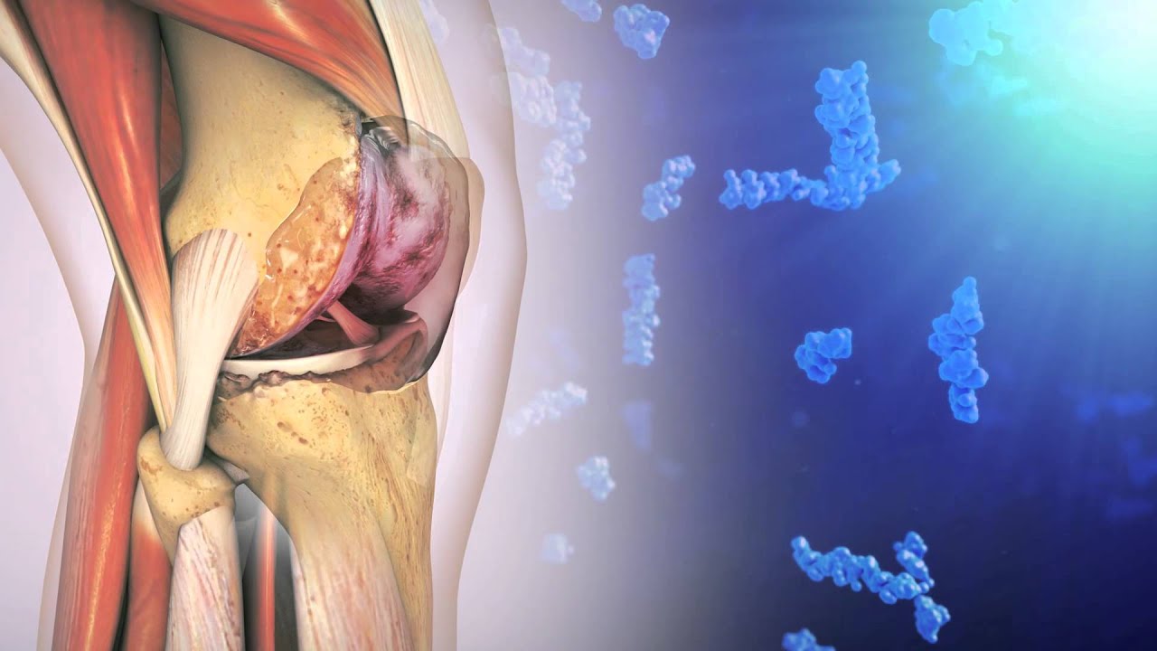 Hyaluronic Acid and Osteoarthritis of the Knee - YouTube