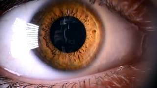 Ячмень или синдром сухого глаза. Тёплые компрессы на веки