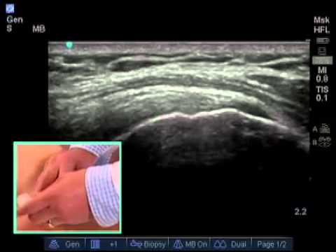 How to: Ultrasound Guided Shoulder Injection - YouTube