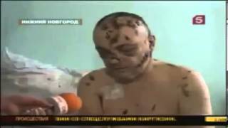 News report shows horrific effects of new drug Krokodil