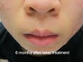 Video: Facial Acne-Asian Girl-Before and After Laser Treatment