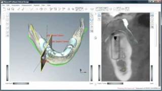 Implantes guiados por ordenador: Planificación virtual