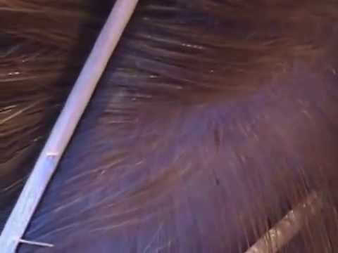 What do lice and nits look like in the hair? - YouTube