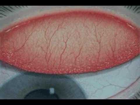 Papillary conjunctivitis.....Grade 1 - YouTube