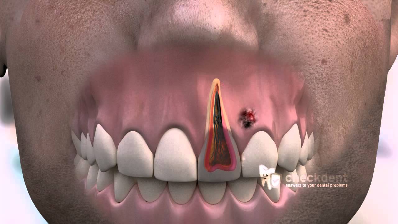 How to treat a dental Fistula - YouTube