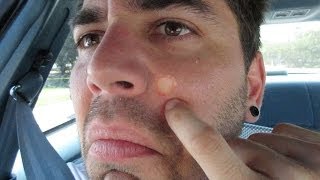 GIANT PIMPLE ON MY FACE!! (6.10.14 - Day 1867)