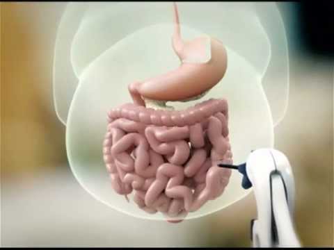 Il bypass gastrico tradizionale - Videoanimazioni Il bypass gastrico tradizionale - Videoanimazioni