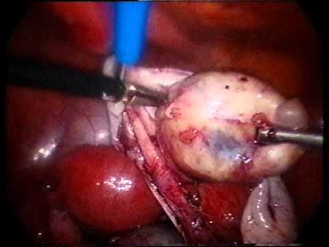 ovarian removal laparotomy teratoma bilateral