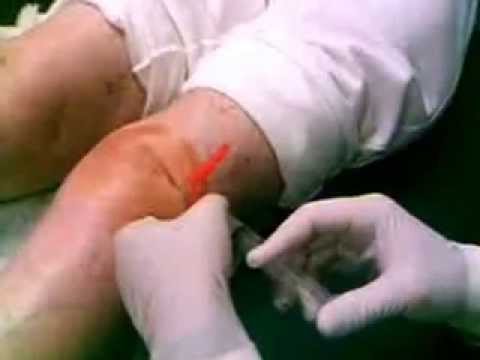 Knee steroid injection youtube