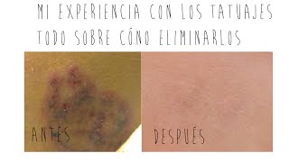 Mi experiencia con los tatuajes | Cómo eliminarlos