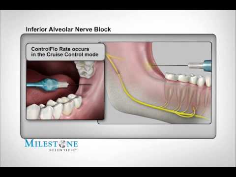 block nerve inferior alveolar injection v3 sites mandibular