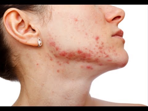 How to Get Rid of Acne Scars Fast - YouTube