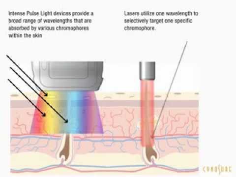 IPL Hair Removal vs Laser Hair Removal - Which is better? - YouTube
