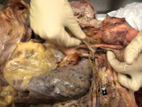 Biology 224 Cadaver: Blood Vessels and Lymphoid system 1 - YouTube