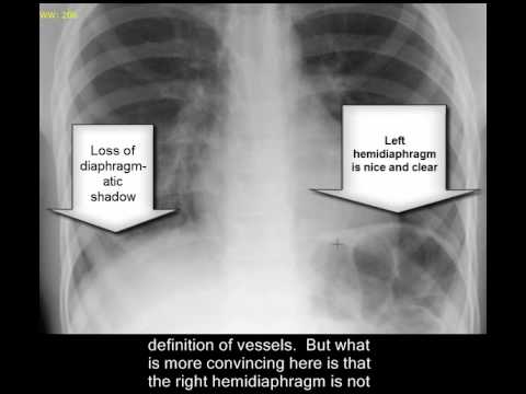 pneumonia x ray findings