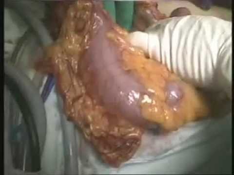 Laparoscopic Colon Resection (Subtotal Colectomy 1 , CA colon) - YouTube