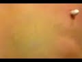 Super grano explotando como toda la pus regada