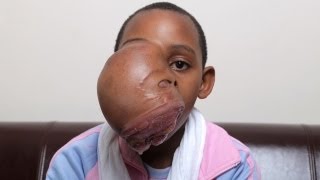 Girl with Unbelievable Face Tumour