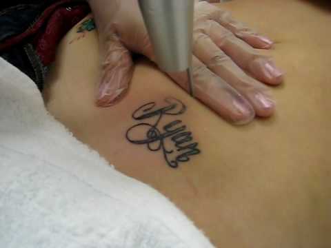 Laser Tattoo Removal 1:01