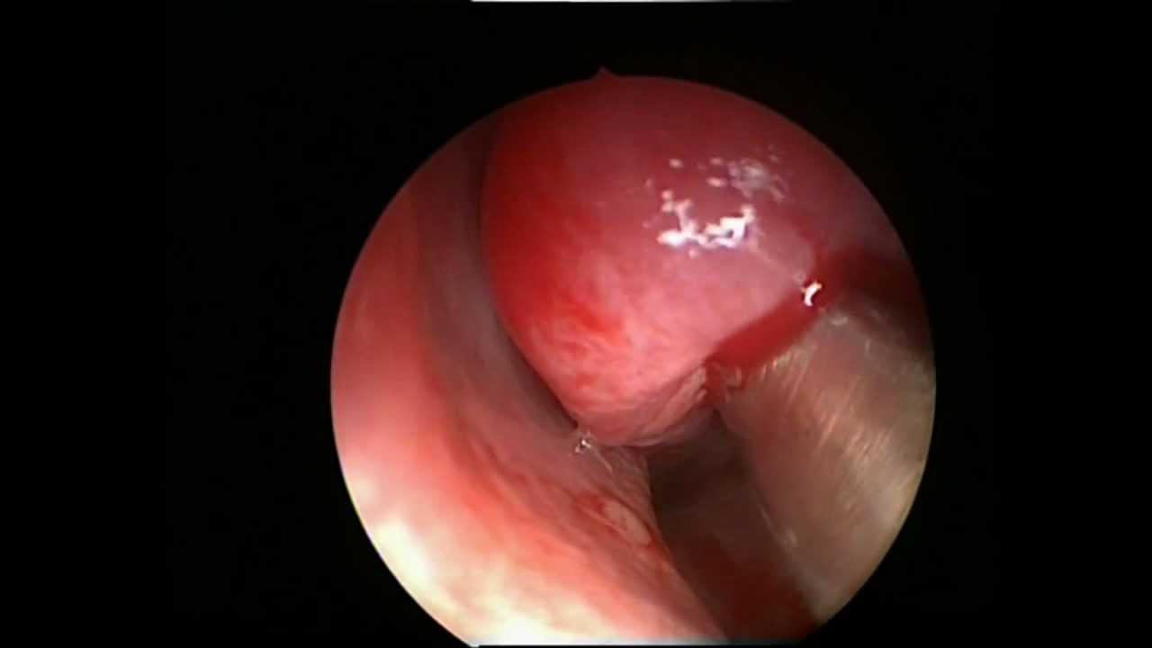 maxillary sinus barriers