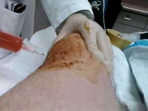 Draining My Knee - YouTube