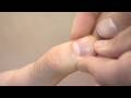 Acupuncture DVD - How to Locate  Acupuncture Points (LU11)
