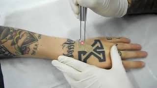 Quitando tatuaje con láser 